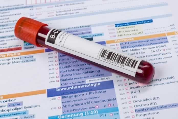 18CC-SUECIA ANALISIS DE SANGRE PARA DETECTAR ALZHEIMER